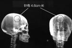 脑里藏针46年 安徽淮北48岁女子脑袋里藏有1枚针起码