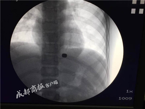 男孩胃里取出磁铁